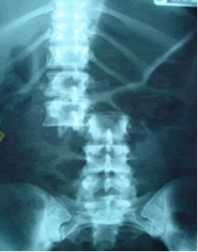 fractura2